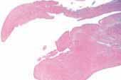 Diffuse-type giant cell tumour N. de St. ubain Somerhausen P.