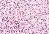 tumour as a sarcoma. ICD-O code 9251/0 Synonyms Pigmented villonodular synovitis, pigmented villonodular tenosynovitis.