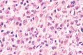 Giant cell tumours may also contain a significant lymphocytic infiltrate.