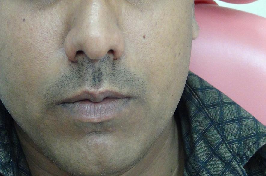 He had visited other surgeons of UAE wherein he was given an extensive cosmetic reconstruction for the same and it was not reachable for him due to the cost.