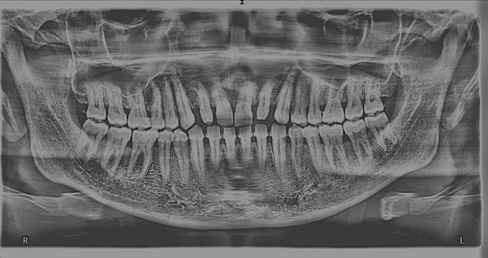 center. On examination he had upper teeth mobile and was suspected dento-alveolar fracture of the anterior maxillae.