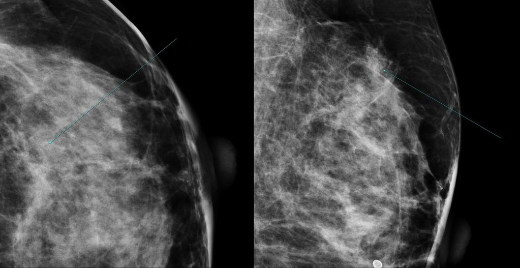 Fig. 1: A 51 years-old female underwent left breast conserving surgery due to