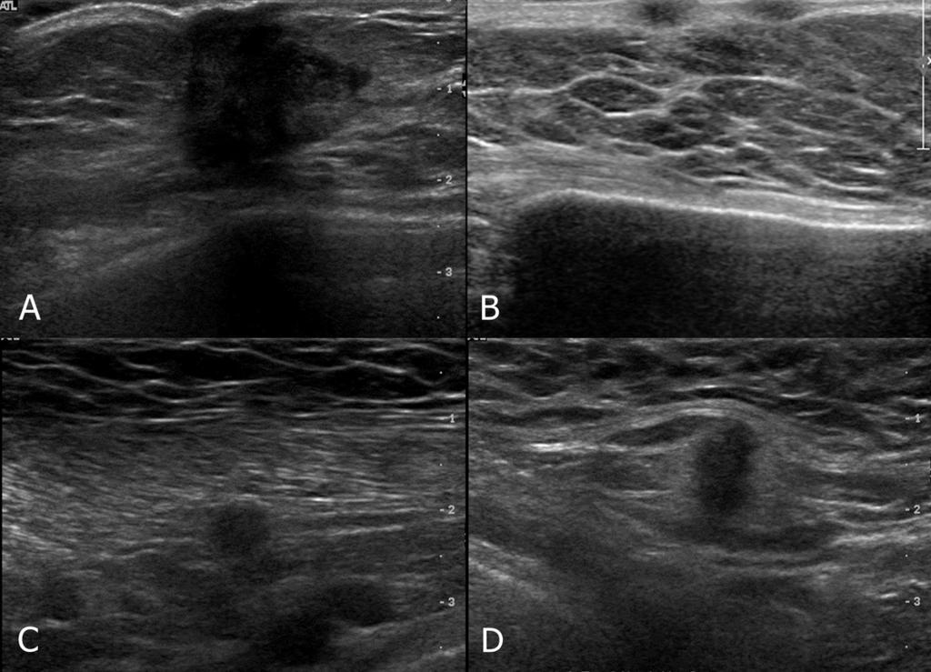 Fig. 4: US images of same patient above.(a) shows spiculated, irregular, hypoechoic mass in the right breast adjacent to the operative site.