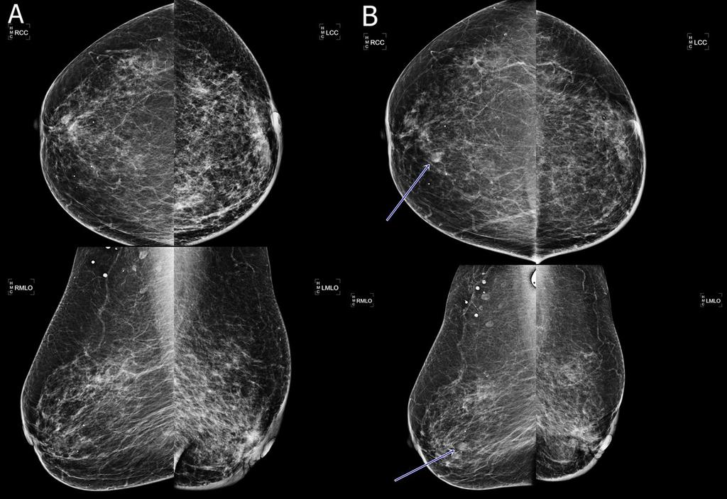 Fig. 6: A 65 years-old female underwent left breast conserving surgery for invasive ductal carcinoma.