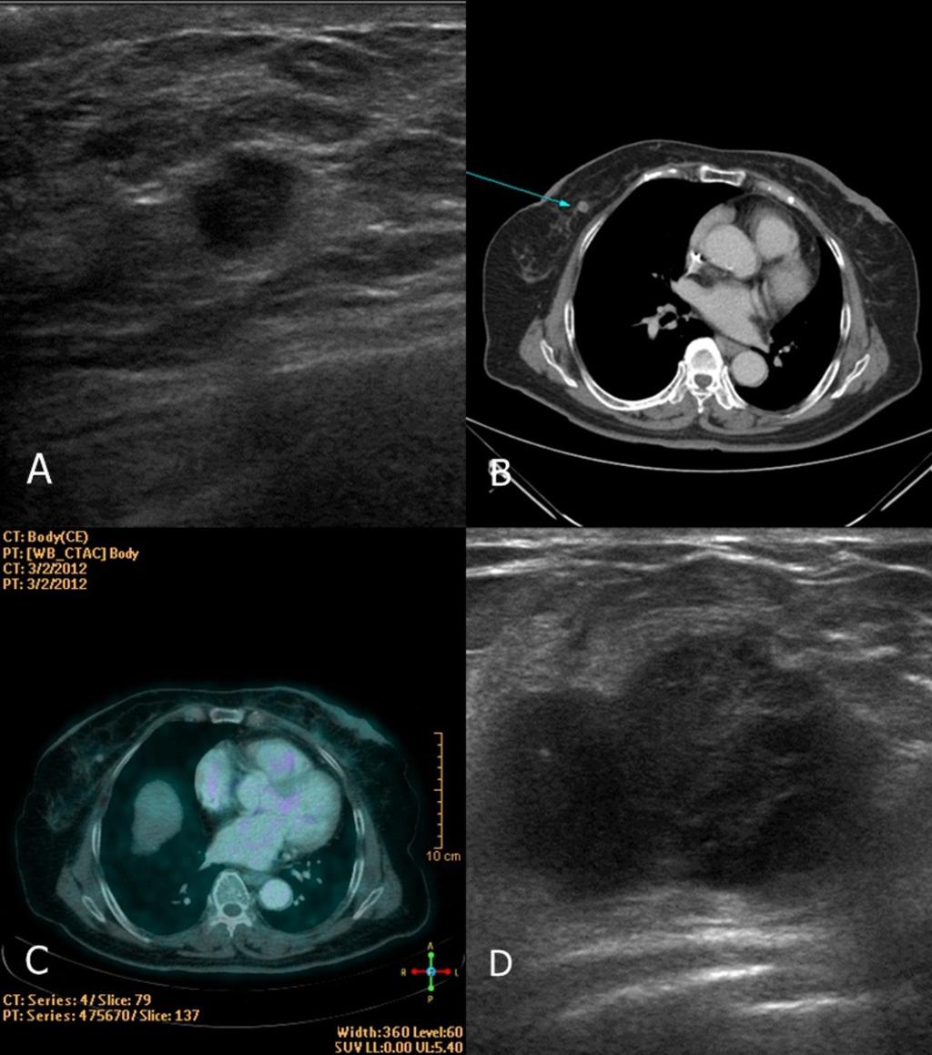 Fig. 7: Another images of same patient above. A microlobulated, irregular hypoechoic mass is noted (A) in the right breast on US, corresponding to the nodule on the mammography.