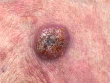If the lymphoma is advanced or doesn t respond to topical treatments,