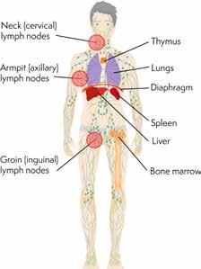 from the abdomen Stage 3 Lymph nodes affected on both sides of the diaphragm* Stage 4