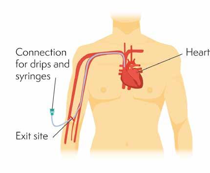 Some people have a central line fitted, for example a Hickman line or a peripherally inserted central catheter (PICC line).