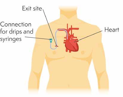 Figure: Central line (inserted into chest) Your nurse should show you how to look after your line to help prevent infection and tell you what to do if you have any problems with it.
