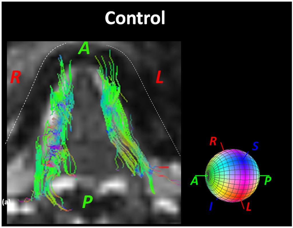 Murano et al. Page 4 Figure 1. IL fiber bundles resulting from the DTI-tractography in the control. Majority of both IL bundles are directly horizontally in the anterior-posterior direction.