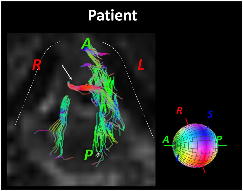 Murano et al. Page 5 Figure 2. IL fiber bundles resulting from the DTI-tractography in the patient. The right IL is thinner and shorter.