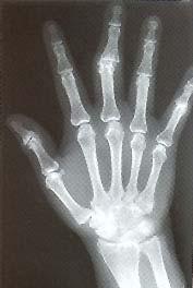 DIAGNOSIS Radiograph showing sharply "punched out" bony defects