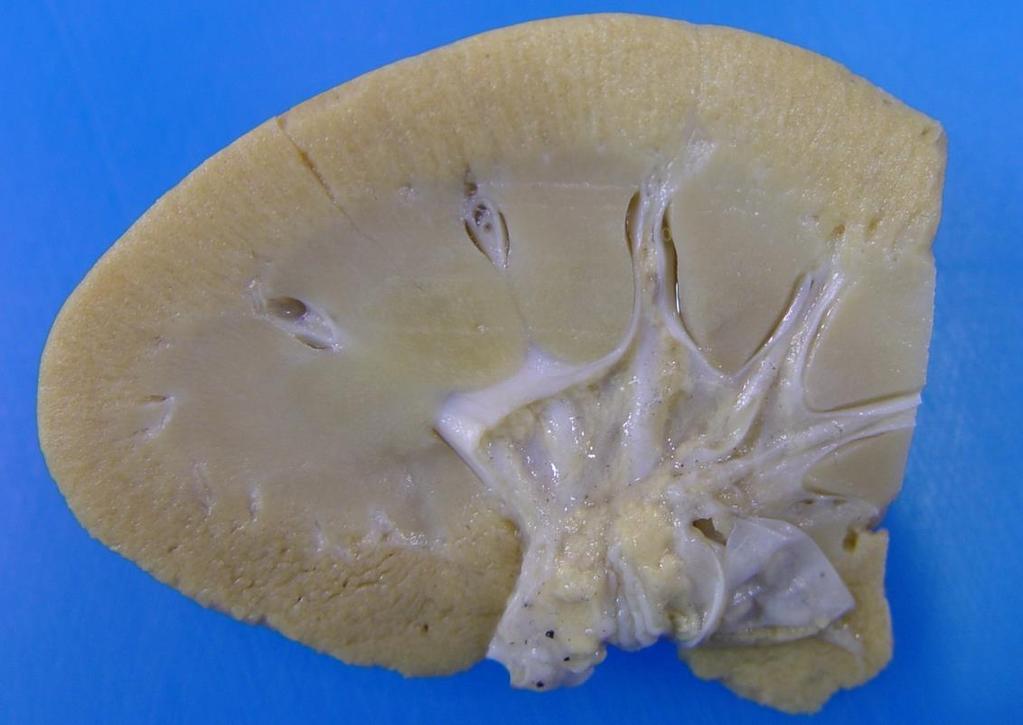 Case 5 Description The kidney is diffusely pale yellow to gold and has multifocal small
