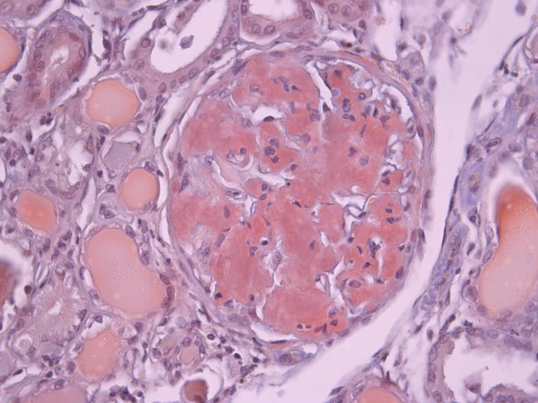 Case 5 Suspected diagnosis Renal amyloidosis Further tests?