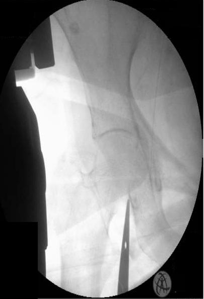 Figure 2: Showing the Tip of the Artery Forceps Placed at the Common Femoral Artery, the Arrow Is Pointng to the Lower End of the Guide Wire, Note the Medial Relation of the Guide Wire to the Common