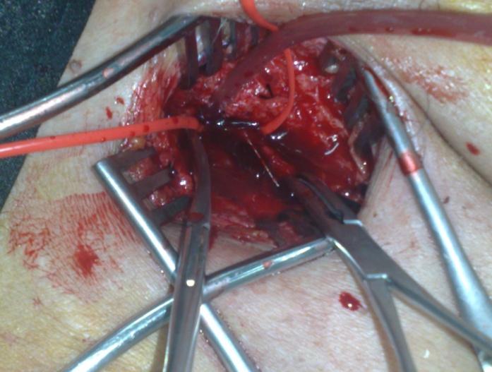 and the venotomy was closed with 6.0 (fine) Polypropylene sutures. Postoperatively, the patient developed a minor lymphatic leak from the incision site.