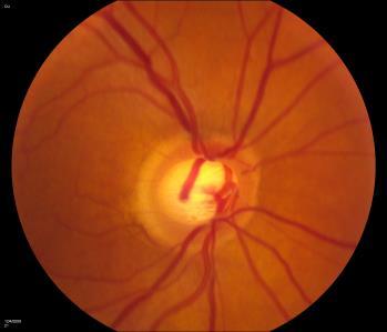 Fig.2. Showing (left to right) normal, suspicious and cupped optic discs A field of vision test may be done. If there is any concern the optician may review or refer to the hospital.