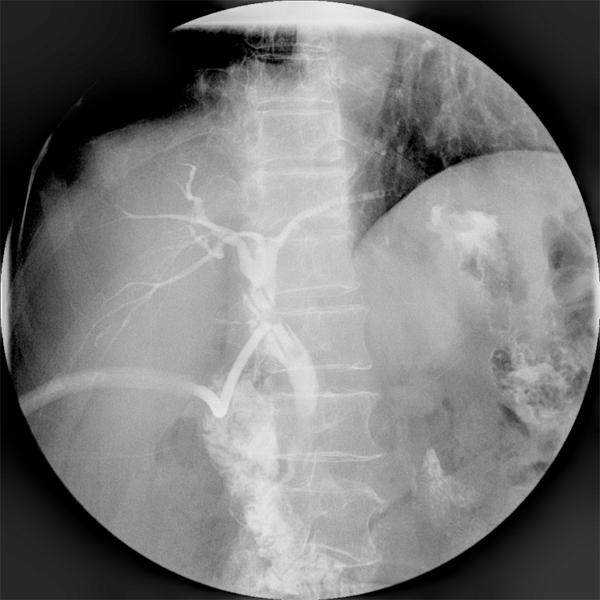 after gastrectomy, the cystic duct should not be divided until the common hepatic duct and CBD are clearly identified. Figure 4. The cholangiogram via T-tube showed no residue stone was found.