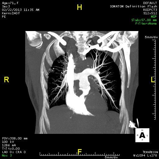 Normal pulmonary angiogram.
