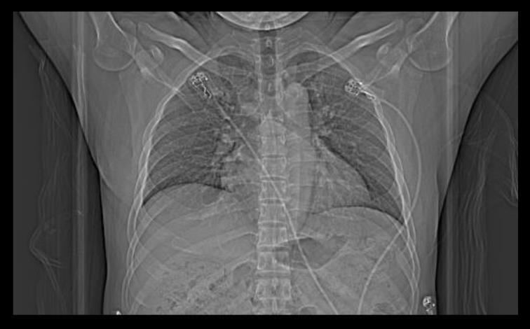Coronary CT Angiography Study Protocols: Siemens SOMATOM Definition AS+ (128 slices/dect) Tube voltage: 120 kvp Tube