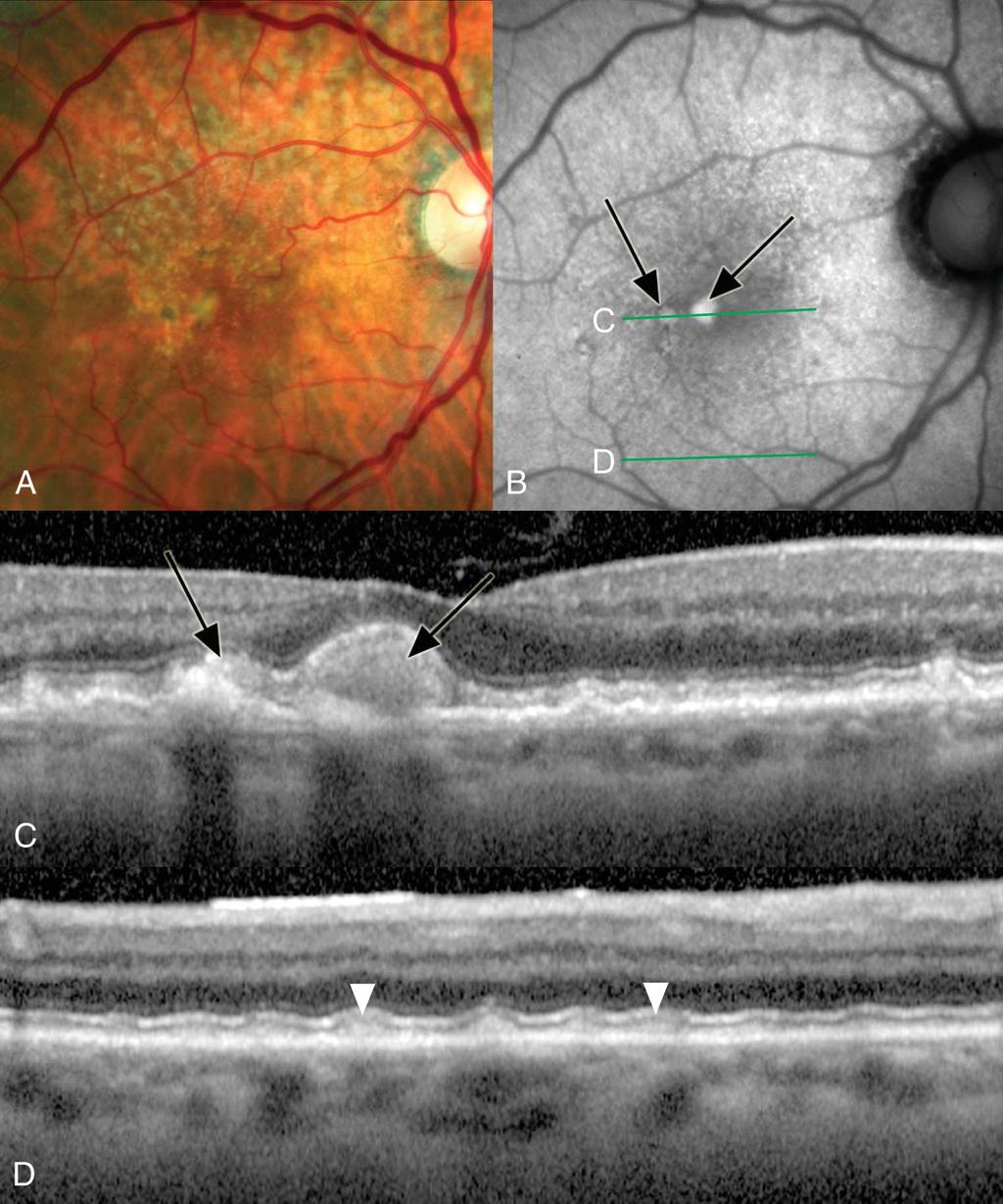 VITELLIFORM DETACHMENT AND SDD ZWEIFEL ET AL 233 Fig. 3. A. The color photograph of the right eye of a 91- year-old woman showing yellowish material and some hyperpigmentation in the center of the macula.