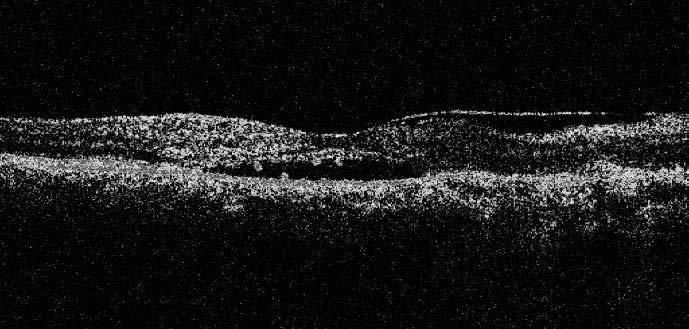 Metamorphopsia is common More common after PVD Tractional macular holes, cysts, CME, neurosensory RD