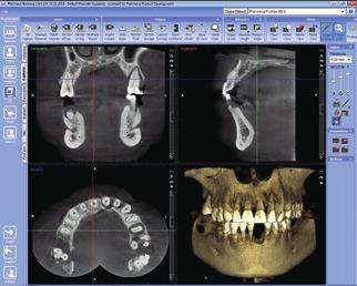 ng size is optimal for e.g. single implant and wisdom