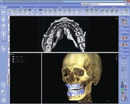 using realistic implant models from several manufacturers.