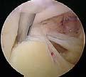 defects at site of cannula Cohen et al (Arthroscopy, 2006) Trans RC portals demonstrated lower ASES scores, increased pain Stephenson et al (JSES, 2012) 6 patients with FT tears following prior SLAP