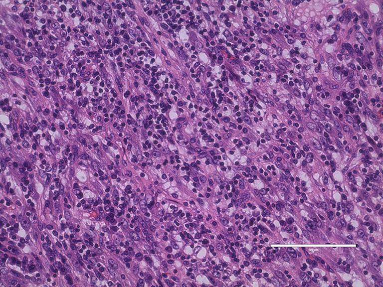 Histopathological and immunohistochemistry of the bronchial biopsy tissue by LK using the iep method ( 400) (D). iep, intercalated antibody-enhanced polymer.