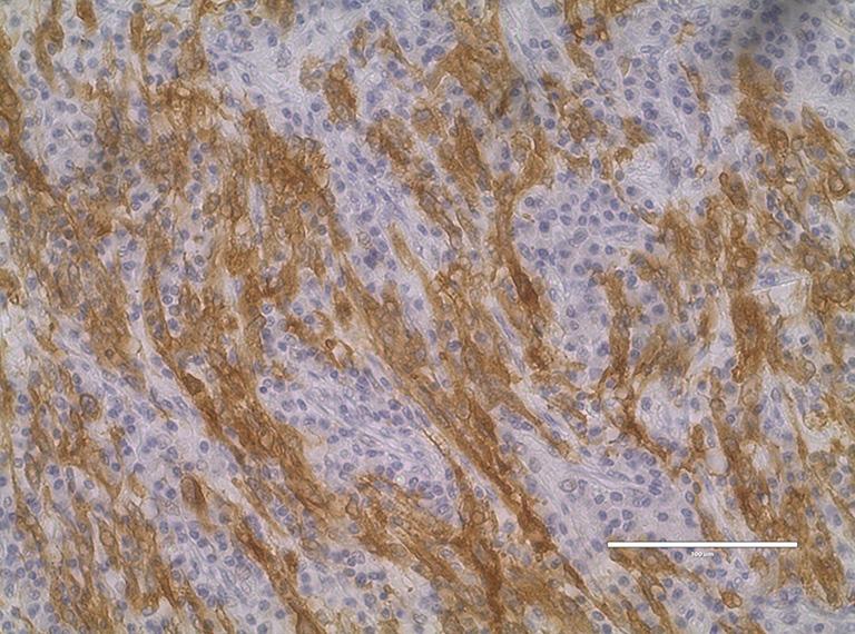 LK translocation analyses by immunohistochemistry, fluorescence in situ hybridization (FISH) or RT-PCR have become almost routine for lung adenocarcinoma patients with EGFR wild type status (1).