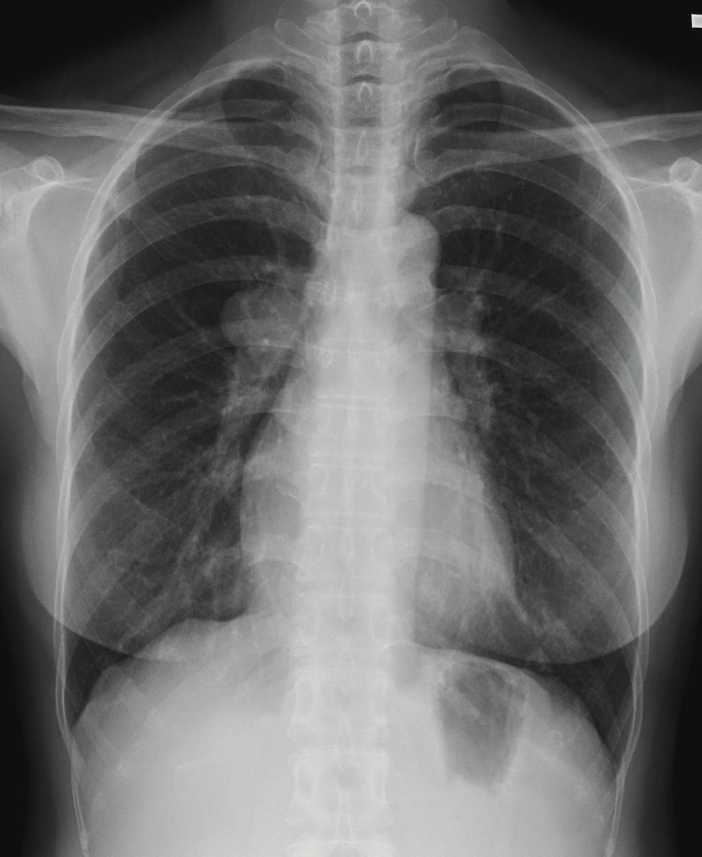 2 (a) (b) (c) (d) Figure 1: (a) Chest X-ray study detects a mass (white arrow) in the right pulmonary hilar region.