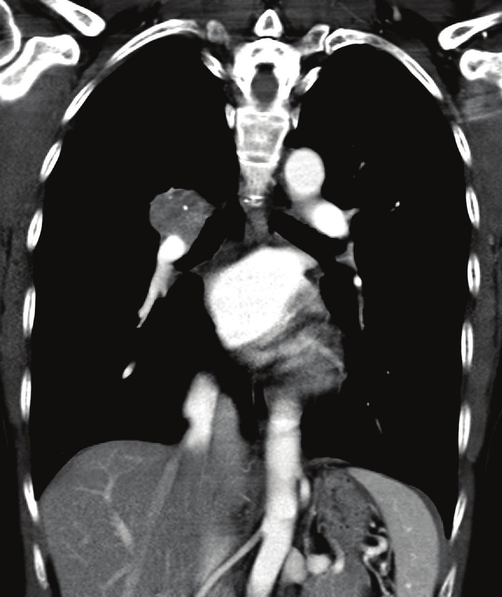 ((b) and (d)) Contrast enhanced CT scan shows a heterogeneous enhanced mass in the right pulmonary hilar region. surface cells arranged in a papillary, sclerotic, solid and hemorrhagic pattern.