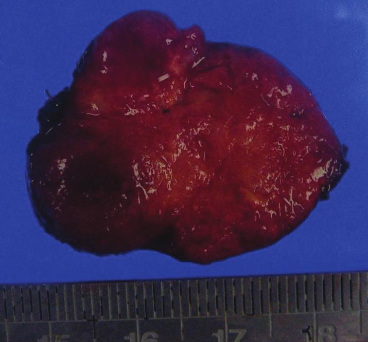 3 (a) (b) (c) (d) (e) (f) Figure 2: Histopathological analysis. (a) The gross specimen of the pulmonary hilar tumor is brownish and well circumscribed.