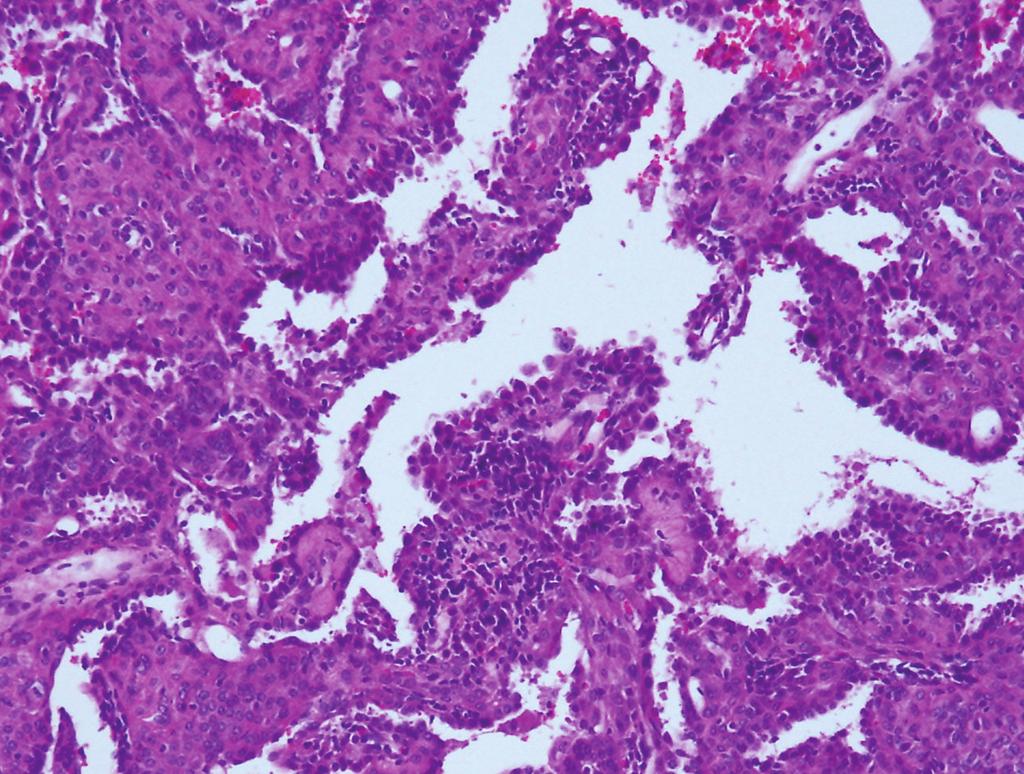 (c) In high power view, papillary configuration is revealed, formed by cuboidal surface cells and round stromal cells (H&E stain, 400).