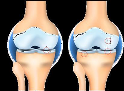 Occurrence of osteophytes Unmet Need Progression to the most severe form of osteoarthritis leaves OAK patients with little to no effective treatment options other than total knee arthroplasty (TKA)