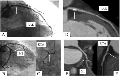 2. RULE OUT CAD Dilated cardiomyopathy associated with severe CAD. Head-to-head comparison of invasive coronary angiography (left panel) compared with MDCT multiplanar reconstruction (right panel).