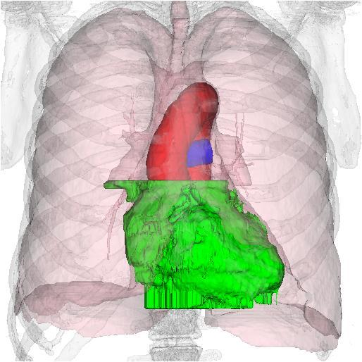 Figure 3. 3D visualization of segmented heart region (green), aorta (red), pulmonary artery (blue), lungs (light pink) and bone (light grey) from 3 different cases.