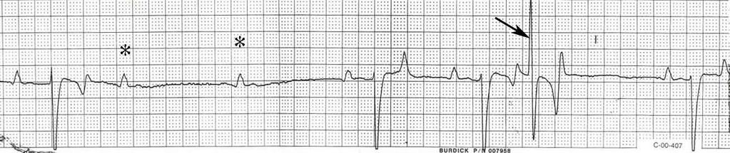 Figure 1. Second Degree AV block. The period of asystole occurs at the arrowhead, when only a P wave is generated. Figure 2. Sinus block. Note the period of asystole between the arrowheads. Figure 3.