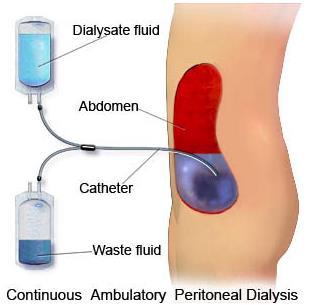 Types of PD Continuous ambulatory peritoneal dialysis (CAPD) Multiple exchanges during the day, followed by overnight dwell Automated peritoneal dialysis (APD) Cycler to perform multiple overnight