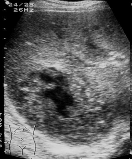 Liver abscess Frankly purulent: cystic, with the fluid
