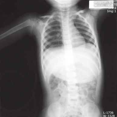 Rocuronium induced anaphylaxis in a child Vol. 59, No. 6, December 2010 tract infection, asthma, atopy, and allergic reactions to foods or drugs.