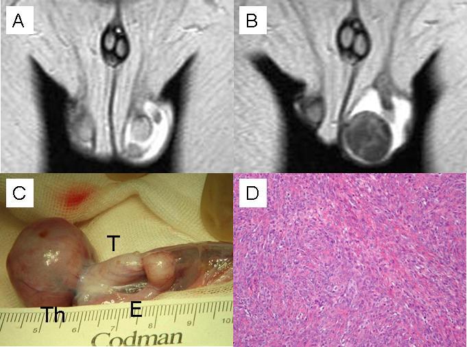 Figure Legends (A) and (B) Magnetic resonance imaging of the left intrascrotal mass (T2-weighted) at first (A) and second referral (B). (C) Gross appearance of the tumor.