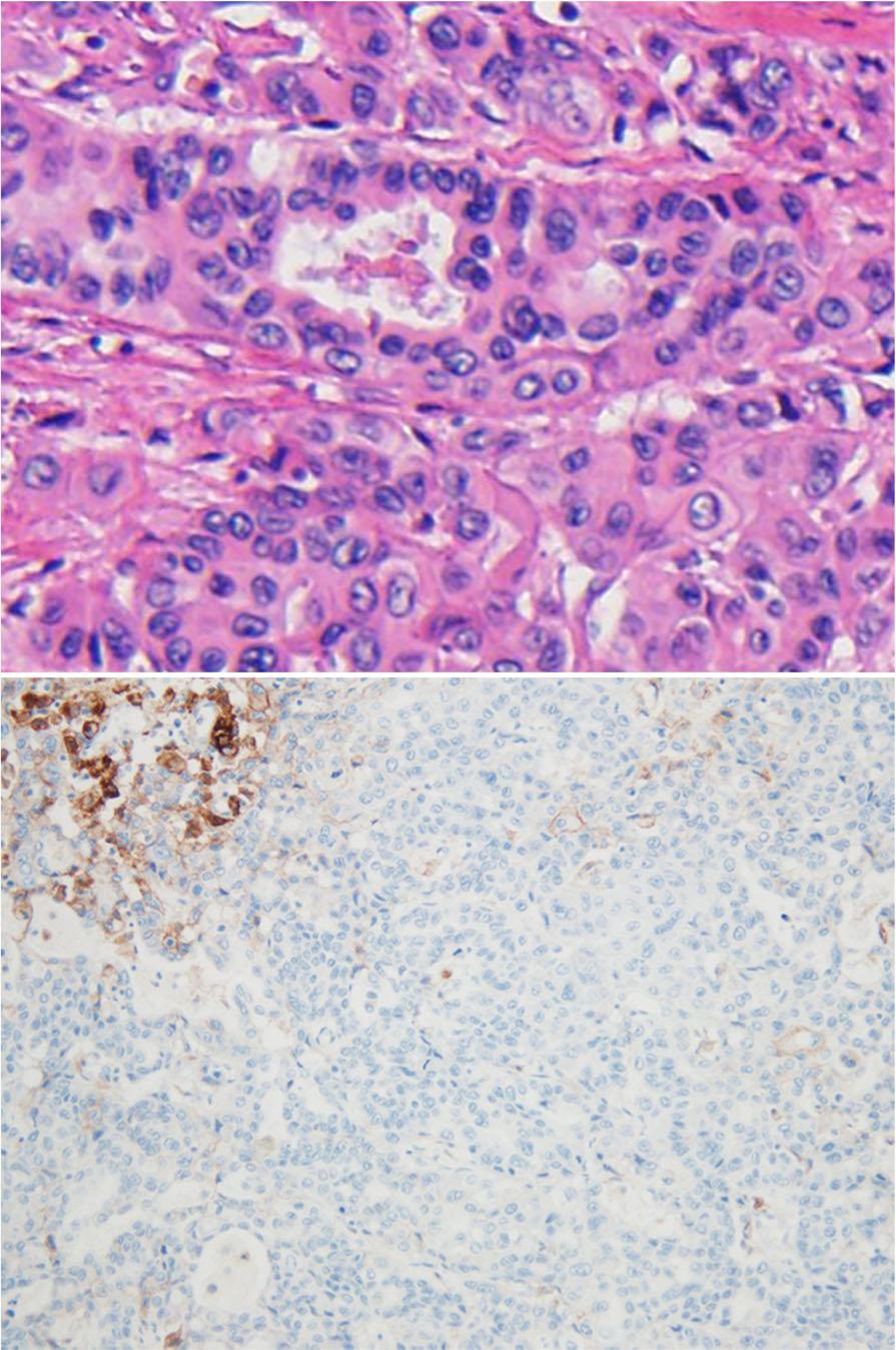 5), which is similr to the score for the tumor tissue otined y ronchoscopy. Overexpression of the MDM2 gene ws not detected y immunohistochemistry.