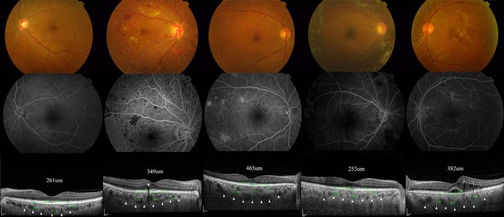 Choroidal Thickness in Diabetic Retinopathy IOVS j May 2013 j Vol. 54 j No. 5 j 3380 FIGURE 1. Fundus photograph (first row), FA (second row), and EDI-OCT (bottom row). First column: no DR.
