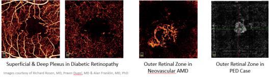 Monitoring diabetic patients Visualizing vascularization in PEDs