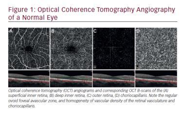 Coherence Tomography Angiography, JAMA Ophthalmol,