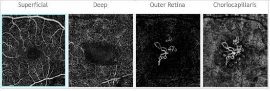 Visualization of macular ischemia Improved