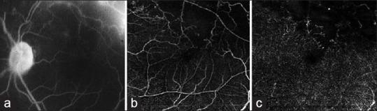 Comparison of fluorescein angiography image (a) in branch retinal vein occlusion with that of optical coherence tomography angiography (OCTA) images obtained at the