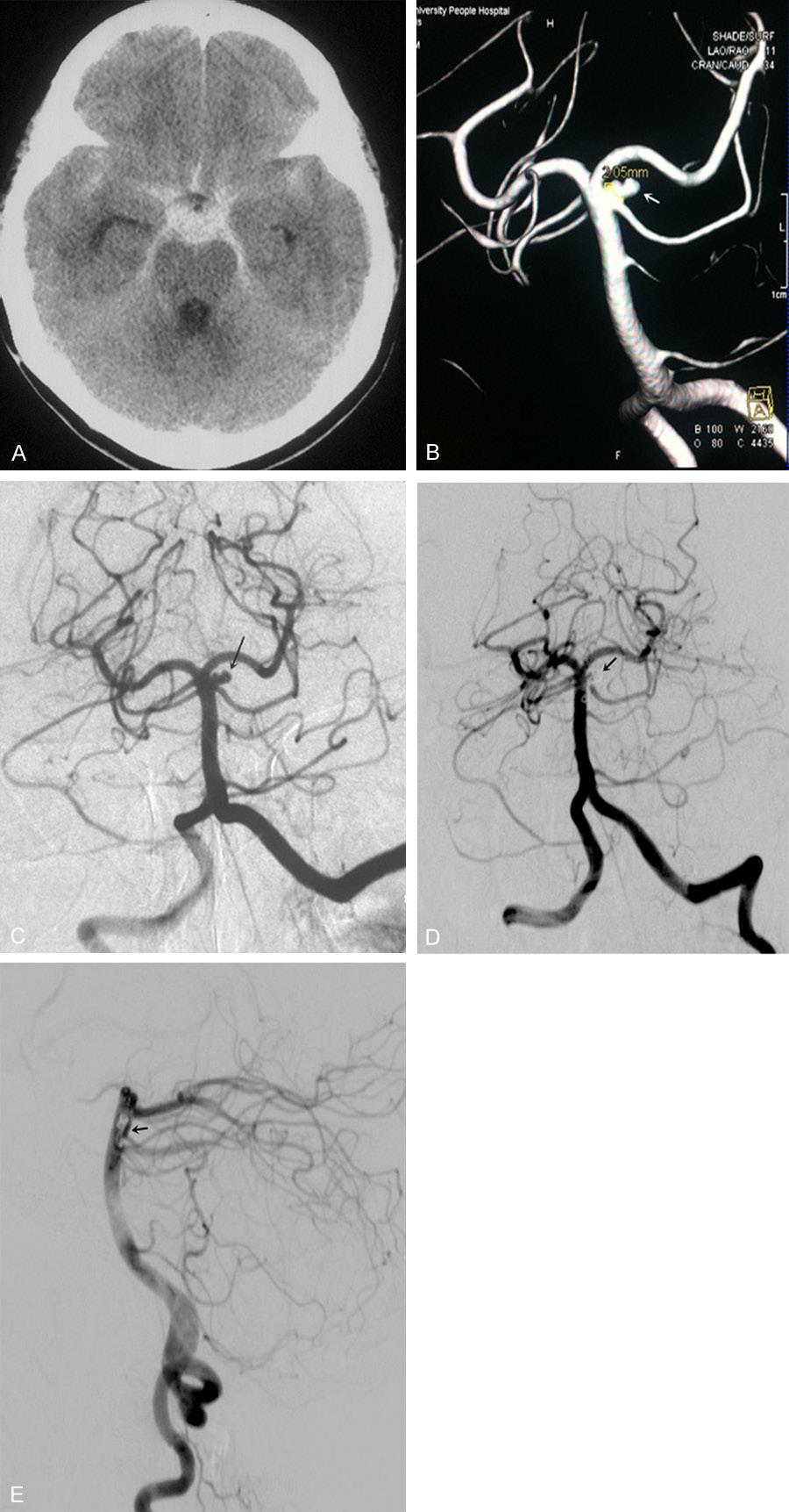 an year showed stable occlusion of the aneurysm with endovascular coil in place (Figure 1E). Case 2 A 52-year-old lady with a history of hypertension, presented with severe headache and Figure 1. A. Computer tomography scan shows subarachnoid hemorrhage (arrows) in the sylvian cisterns.